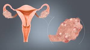 PCOS Treatment Plan